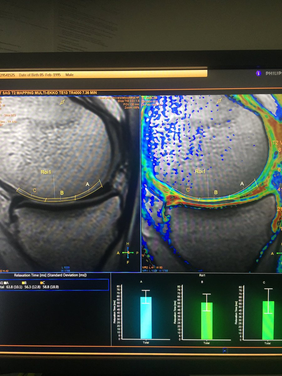 Bruskskade's tweet photo. How reliable is T2 mapping? We’re looking into the reliability and clinical consequences of T2 mapping results in #cartilage surgery patients. To be continued... @CartilageRepair #t2mapping https://t.co/DBdXF1tSv9