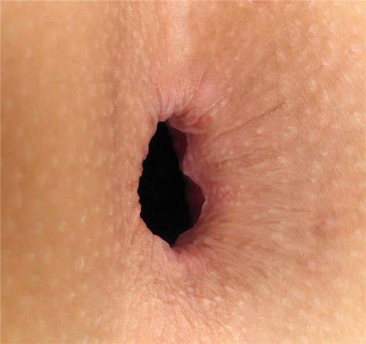 videos-hot-normal-skin-tag-anus-inchtures-prepon