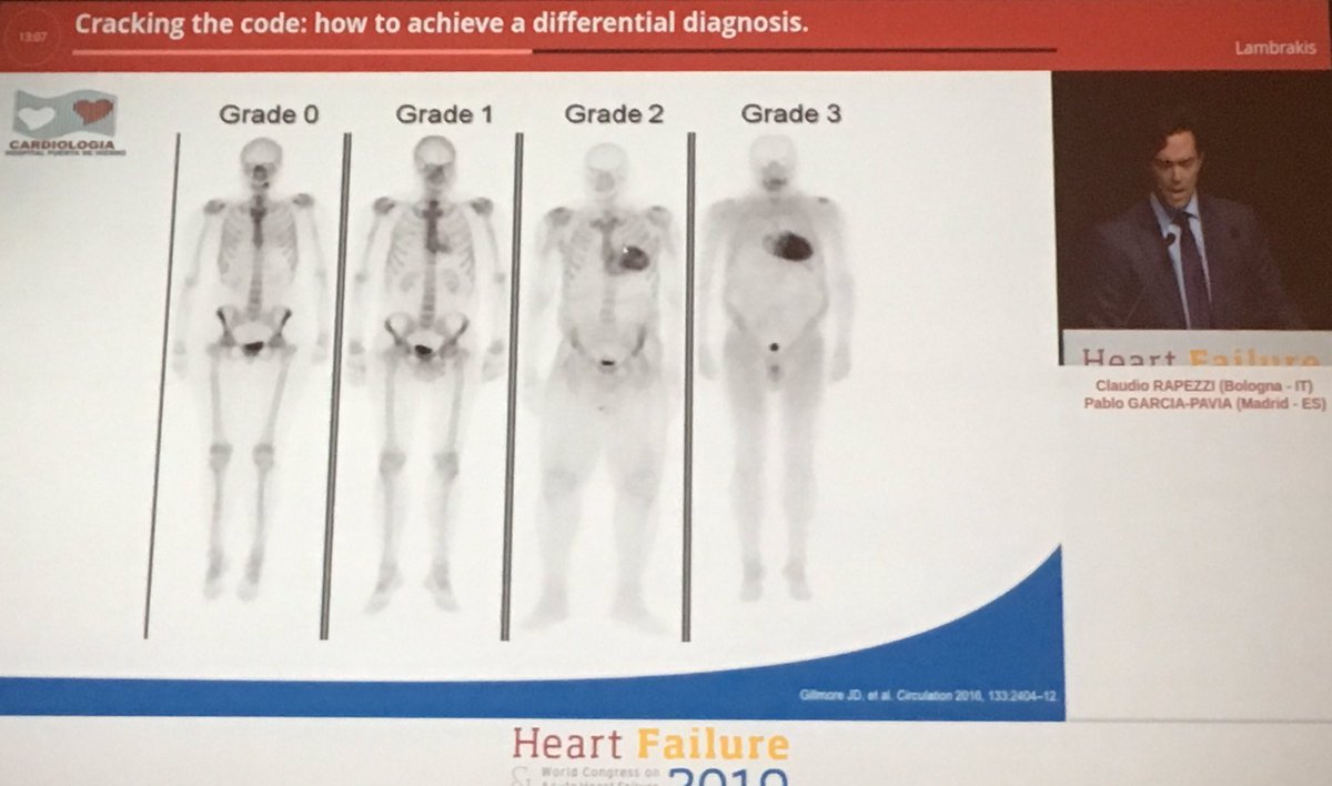 GiuseppeGalati_'s tweet photo. #Heartfailure2019 Prof Rapezzi &amp; Dr Garcia-Pavia increasing the awareness of #ATTR #Amyloidosis From prevalence to Differential Diagnosis. 
Please keep the messages in your mind #HFcommunity
🔥🔥🔥@Filippatos 
@escardio @MihaiTrofenciuc @ShelleyZieroth @hvanspall @SABOURETCardio https://t.co/K9wRJsCuyX