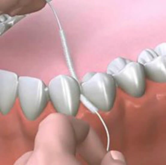 DentaGama on X: Superfloss can clean around braces, implants, bridges or  wide gaps. It consists of a stiff end, making it easy to insert between  braces and under retainers. Attached to the