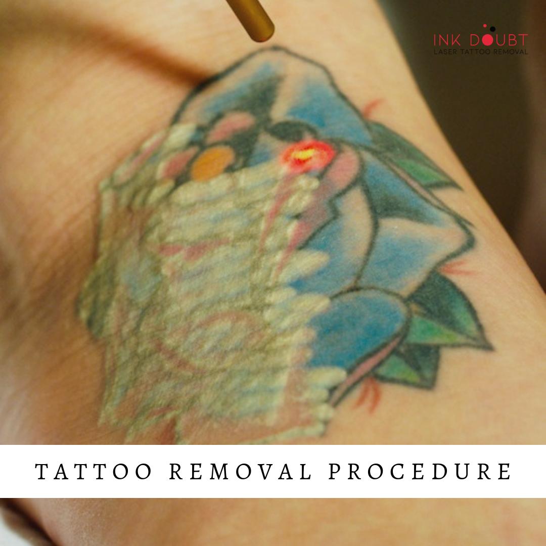 Laser Tattoo Removal  Colorado  No Regrets Laser Services