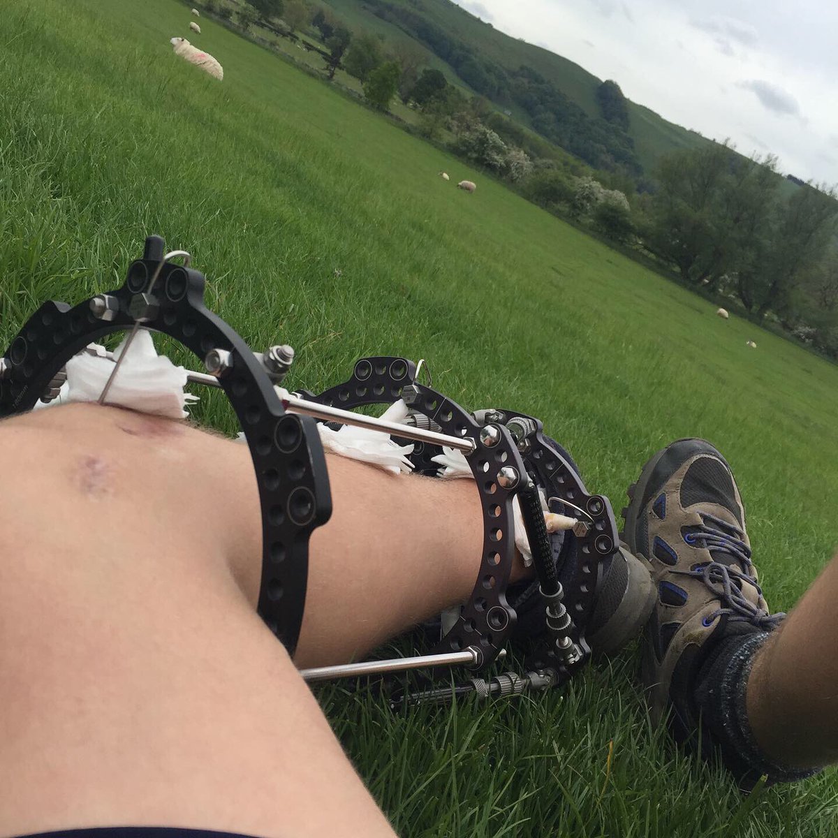 pitstopdotp's tweet image. Duke of Edinburgh Silver Expedition smashed this weekend with an external fixator on! You rock Jack.💪🏻 @silcoatesschool @SilcoatesSport @DofE