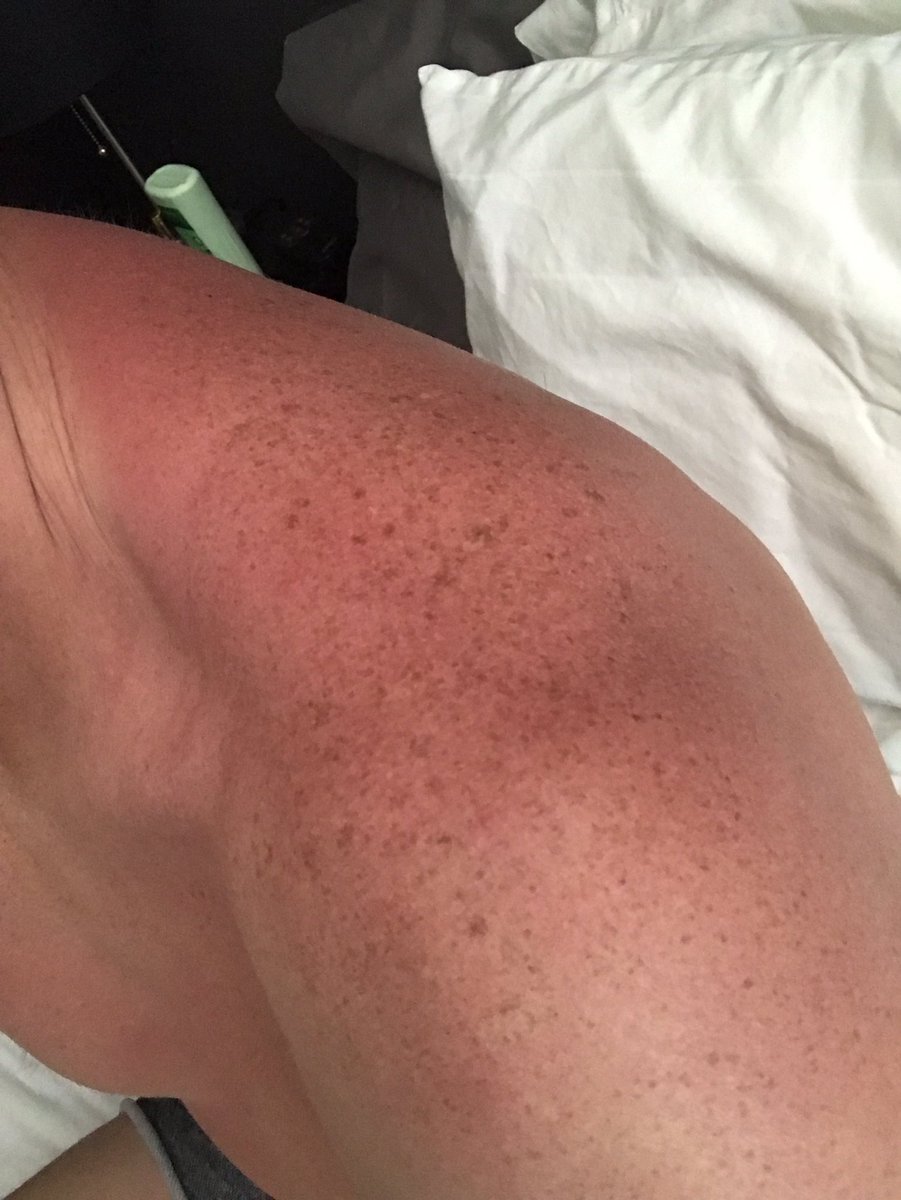 Sunburns SUCK!