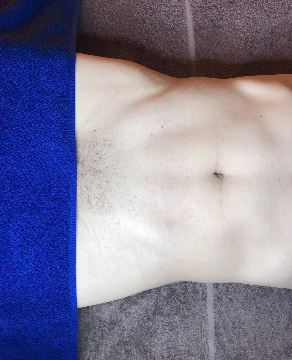 新宿メンズブラジリアンワックス脱毛サロンnadio على تويتر メンズブラジリアンワックス ビフォーアフター 施術前 脱毛1か月経過 一部脱毛 中心部 完成系 オールオフ 毛量 毛質により異なりますが施術時間は50 60分程度です メンズ脱毛