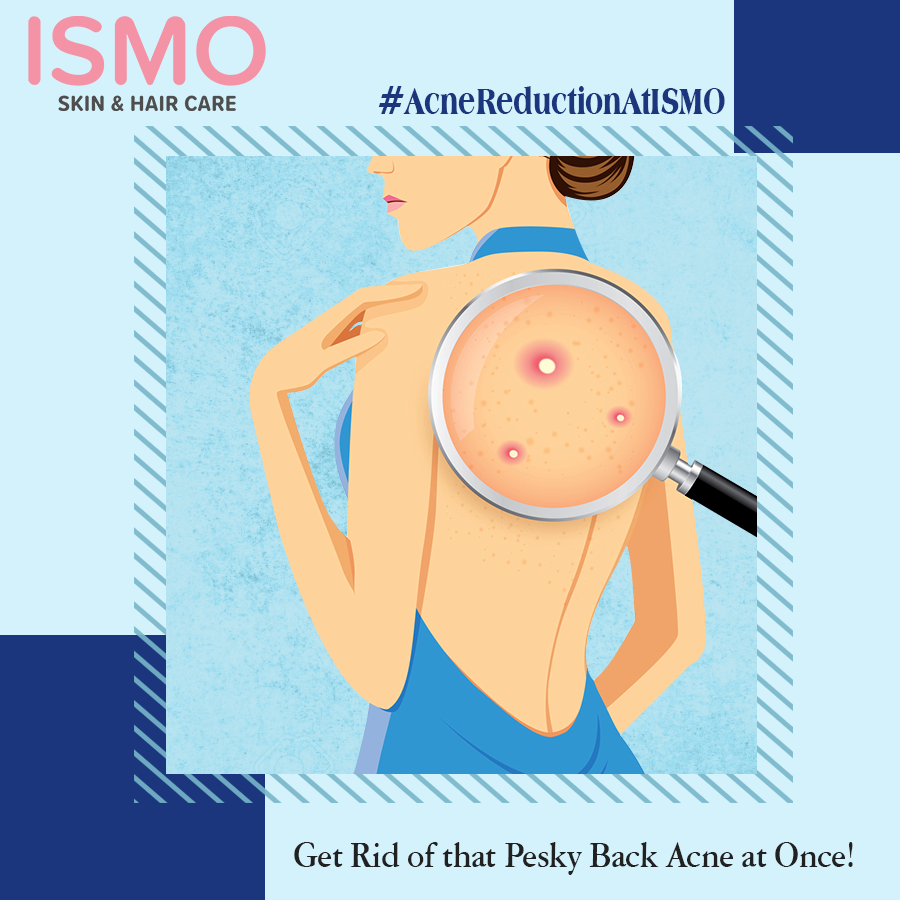 Acne on your back? We've got you covered. Visit ISMO to avail the 100% safe and effective acne removal treatments.

To book appointments now, call 044-24660222

#backacne #acneremoval #ismo #skincare #chennai #haircare #skinclinic #beauty #health #wellness