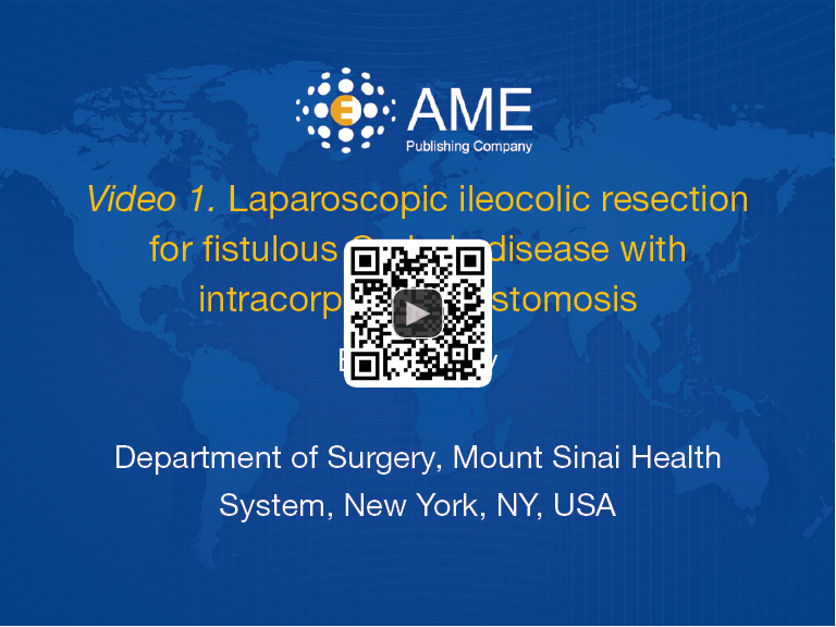 ALES_Journal's tweet photo. Laparoscopic ileocolic resection, division of entero-entero fistula, and intracorporeal anastomosis by Dr. Barry Salky, at https://t.co/ZyavqyU4Zw. https://t.co/USUyzuKxtx