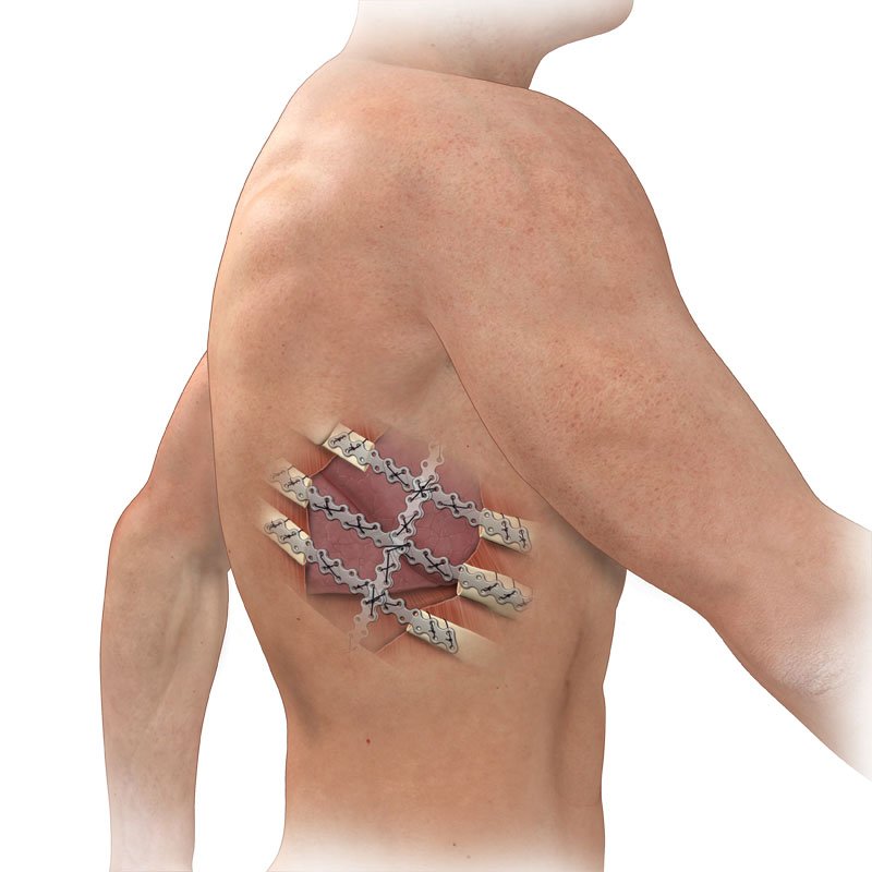 NIRHUS_MD's tweet photo. Find out how patients with multiple rib fractures, flail chest, tumor removal, and radiation injury may re-gain structure and functionality of their chest wall. #innovation #Surgery #DrNirHus #Emergency #OR #brokenribs #chestwall #reconstruction #nirhusMD https://t.co/Rsl89Hoz4Q