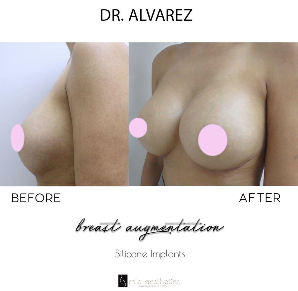 Mia_Aesthetics's tweet photo. #before and #after by #DrAlvarez #BreastAugmentation https://t.co/NjLEbPePtE