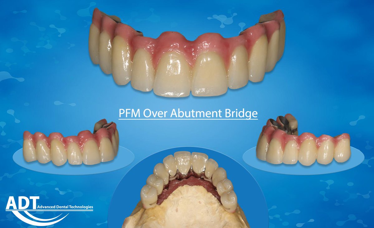 AdvDntlTech's tweet photo. https://t.co/XSNH36MiOr
#ADT #AdvancedDentalTechnologies #Dental #Dentistry #LoveOfTeeth #SendUsYourScans #SendUsYourImpressions #DentalLab #ToothArt #AdvancedDentalLab #PFM #ImplantGurus #TiCustomAbutments #CustomAbutments https://t.co/N9uVYTS3lj