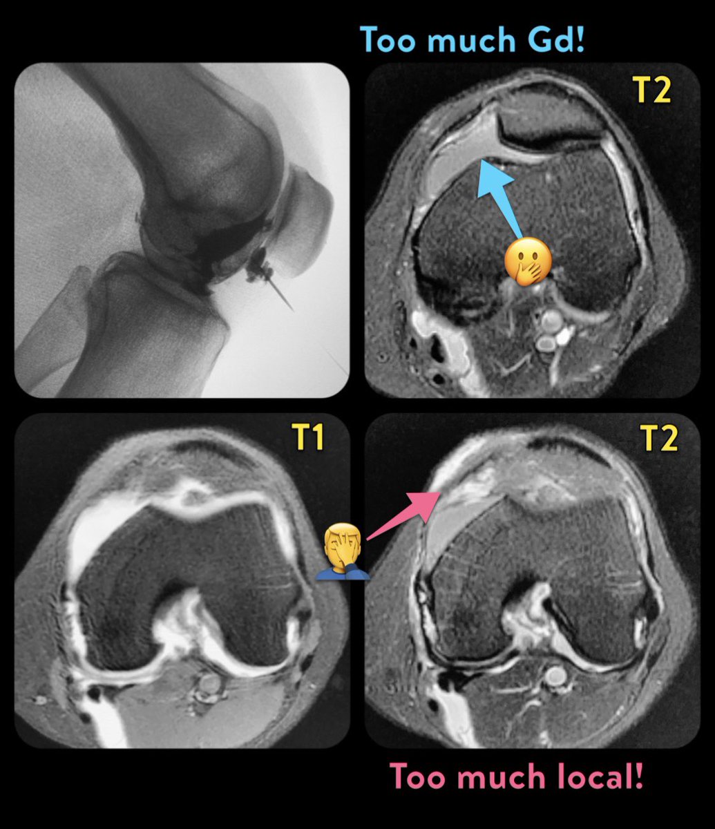 morrisonMSK's tweet photo. For MR arthrography, Gd concentration should be 2.5mM... 1:200 dilution for most preparations, 1:400 for Gadavist. If you have TOO MUCH Gd, it will look like this, dark-ish on T2! 
[also don’t load the SQ with lido- unless you want more pain when it wears off!!] https://t.co/gdwHuWpELX