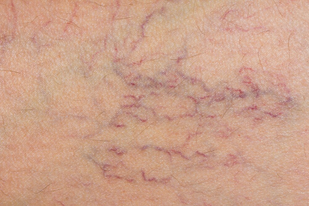 Unwanted spider veins is no accessory for your pretty outfit! It’s time you stopped covering up your legs and started treatment with Derma Laser Center. dermalasercenterny.com