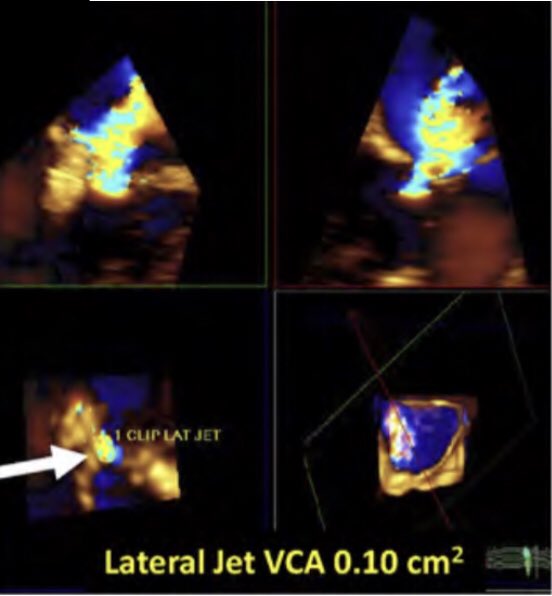 Ritu Thamman MD on Twitter "2)Use 3D vena contracta area(s)of the MR