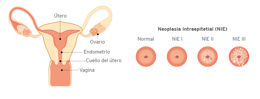 tumor en el utero maligno tumor en el utero maligno