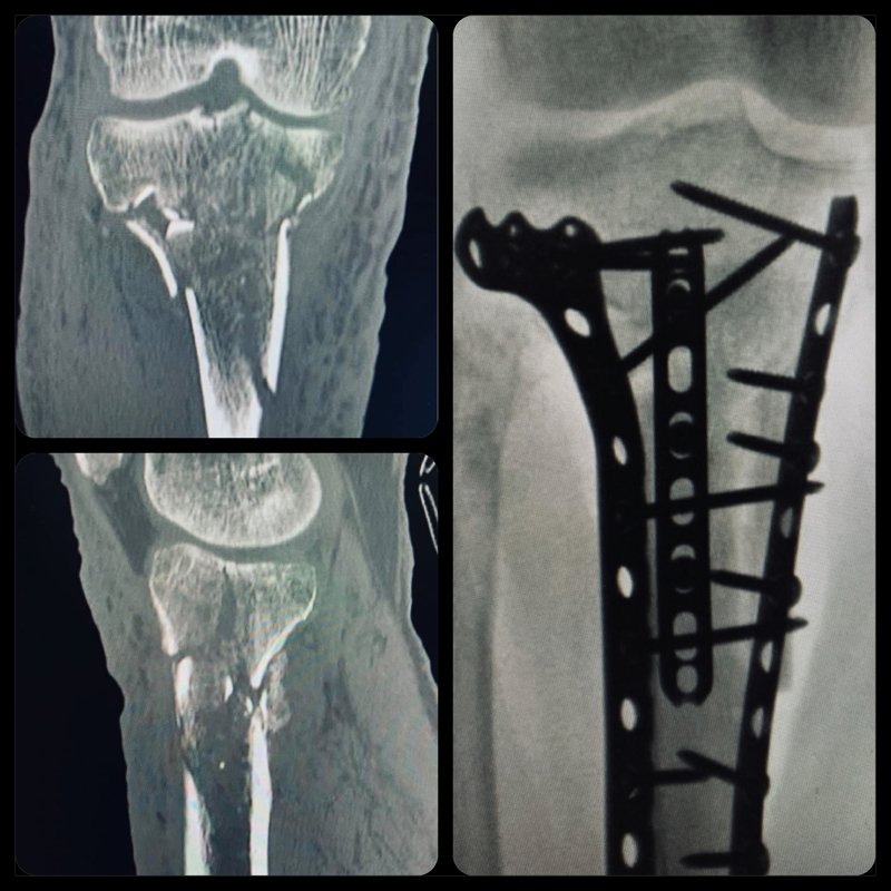 IAmDoctorDan's tweet photo. EVERYTHING BUT THE KITCHEN SINK: Sure Was Interesting (And Fun) Piecing It Back Together, But We Don’t Recommend You Trying This At Home . . As I’m Always Happy To Manage Your Serious Injury

Primum Non Nocere,
#DoctorDan
#DoctorDansBodyShop #ORIF #TibialPlateauFracture https://t.co/uXKoHFwPxj