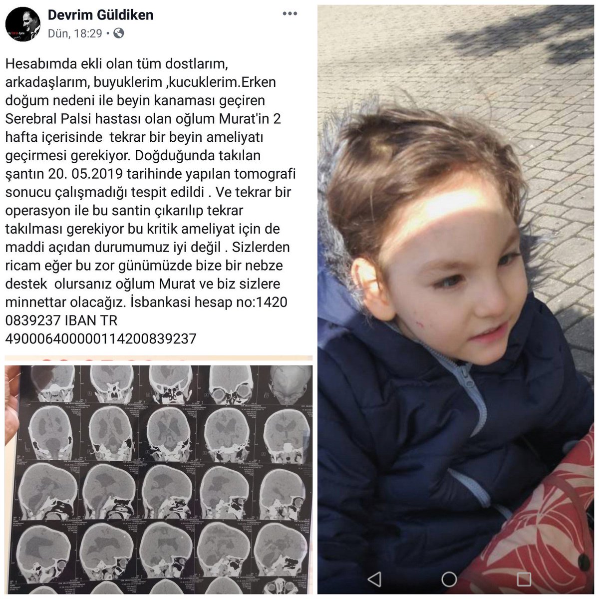 Dostlarım yeterli miktara henüz ulaşamadık paylaşım yaparak destek olursanız oğlum Murat'ın ameliyatı için daha fazla yardım eline ulaşabiliriz . Allah herkezden razı olsun