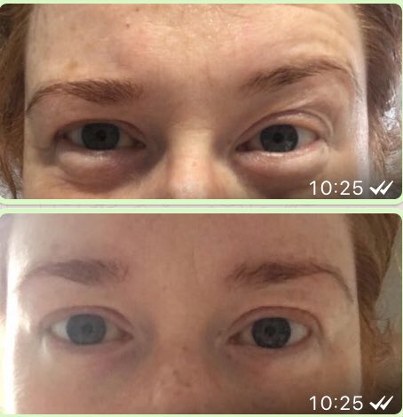 Being a rather busy person, I tend to forget about looking after myself! However, after 20 mins the #arbonnegeleyemasks I’m speechless😊🙄

2 x Poorly babies and I’m a bit pooped! Love this result!!! 😊

pic 1 - 9.46am & pic 2 - 10.22am. #arbonne #arbonneuk #arbonneskincare