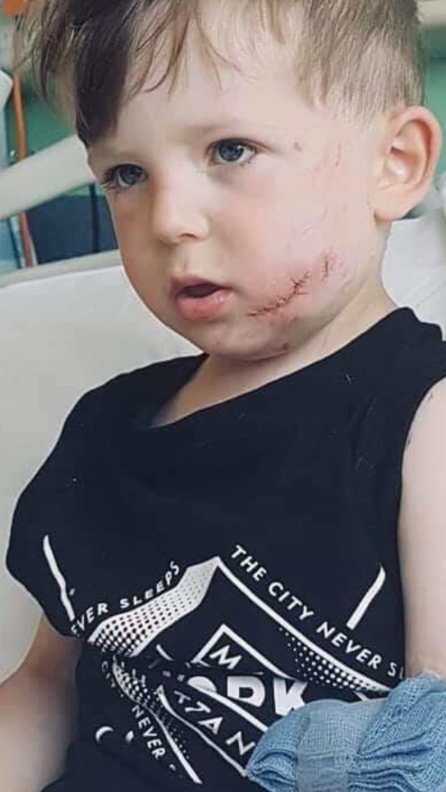 3 year old Oscar’s face was mauled by a dog while on a family day out at a bike rally in Lincolnshire on Monday. His mother wants dogs banned from events with children. More on <a href="/looknorthBBC/">BBC East Yorkshire</a> at 6.30.