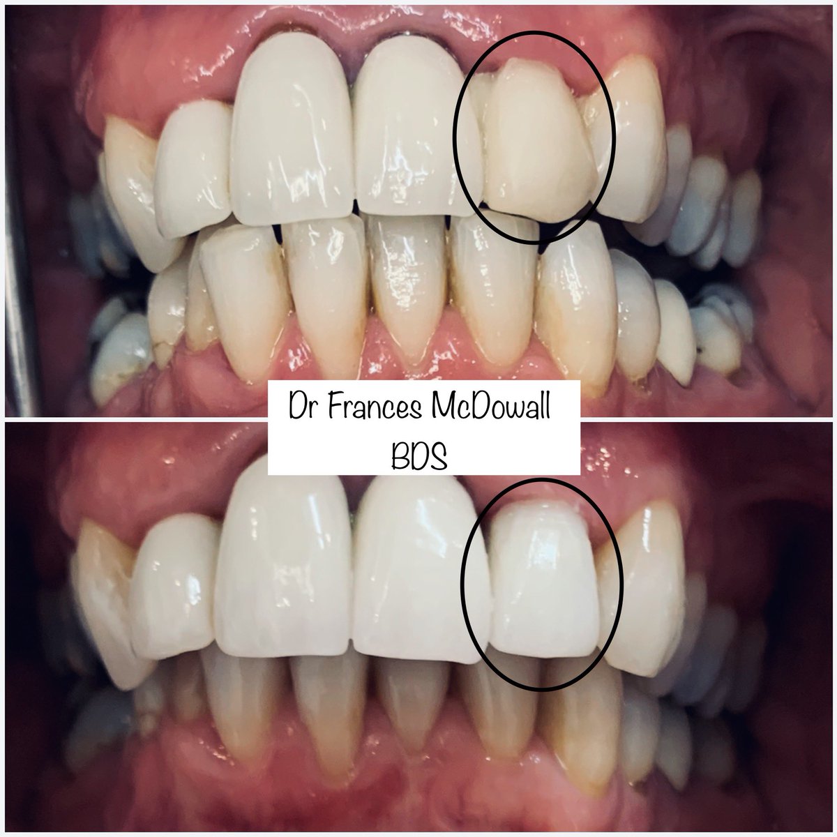 WhitemossDP's tweet photo. All dental treatment including crowns unfortunately does not last a lifetime (if only 🤨) 
•
But look how well we can match new crowns to existing crowns to keep our patients smiling!! 

#dentist #dentalpractice #eastkilbride #beforeandafter #glasgow #scotland #dental #teeth https://t.co/oY5YdvvVou