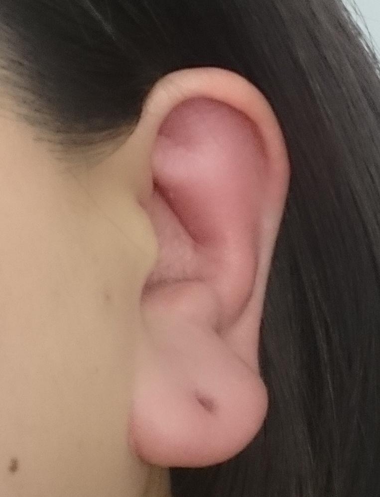 耳性帯状疱疹