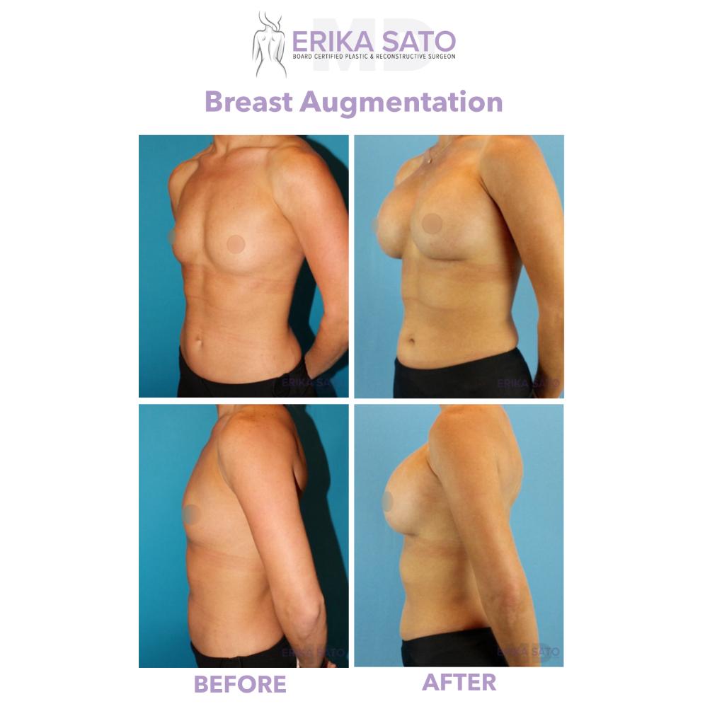 Dr. Erika Sato on X: This 33-year-old female patient underwent a  #BreastAugmentation using 415cc Sientra 106 Textured Round Moderate Plus  Profile Silicone Breast Implants. (713)799-8989   #DrErikaSato #Texas #TX #Makeover