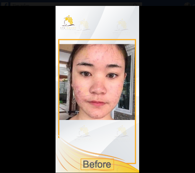 SpaTraicay's tweet photo. SẠCH MỤN - MỊN DA VỚI #SPATRÁICÂY
Tư vấn hoàn toàn MIỄN PHÍ với Bác sĩ da liễu.
LẤY NHÂN MỤN CHỈ #199K> - ĐIỀU TRỊ MỤN THEO CHUẨN ĐOÁN CỦA BÁC SĨ DA LIỄU.
SPA TRÁI CÂY 🍏🍎🍊🍋
📍 Địa chỉ: 177 Trương Định, P.9, Q.3, Tp.hcm
🌐 Website: https://t.co/5NJJLVhU73 https://t.co/RfJrXEvEa0
