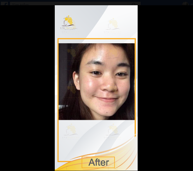 SpaTraicay's tweet photo. SẠCH MỤN - MỊN DA VỚI #SPATRÁICÂY
Tư vấn hoàn toàn MIỄN PHÍ với Bác sĩ da liễu.
LẤY NHÂN MỤN CHỈ #199K> - ĐIỀU TRỊ MỤN THEO CHUẨN ĐOÁN CỦA BÁC SĨ DA LIỄU.
SPA TRÁI CÂY 🍏🍎🍊🍋
📍 Địa chỉ: 177 Trương Định, P.9, Q.3, Tp.hcm
🌐 Website: https://t.co/5NJJLVhU73 https://t.co/RfJrXEvEa0