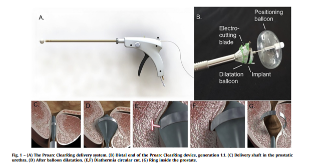EAU_uroluts's tweet photo. ClearRing joins the circle of novel minimally invasive treatments for male LUTS. Read more https://t.co/MxTAR9g0dN

@UrowebESU @EUplatinum #maleLUTS #bph https://t.co/uSm348w3Ke