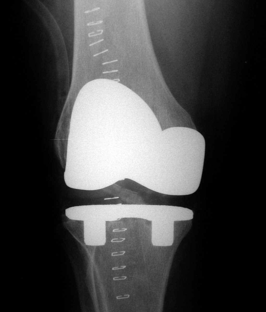 MetrOrtho's tweet photo. Metro Orthopedics (metrOrtho) . . World-Class Orthopedic Traumatology, Joint Reconstruction &amp; Treatment Of Spinal Disorders . . Medical Practice Of Dr. Daniel Ivankovich https://t.co/mu1ewwGnkx