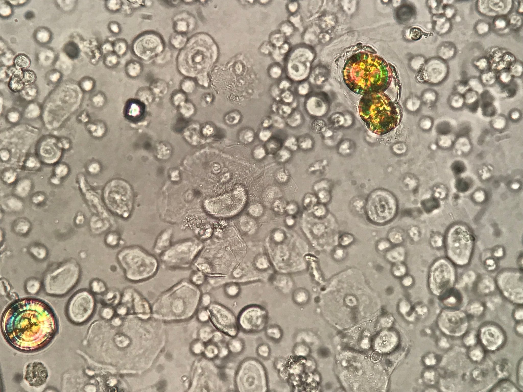 Leucine Crystals In Urine
