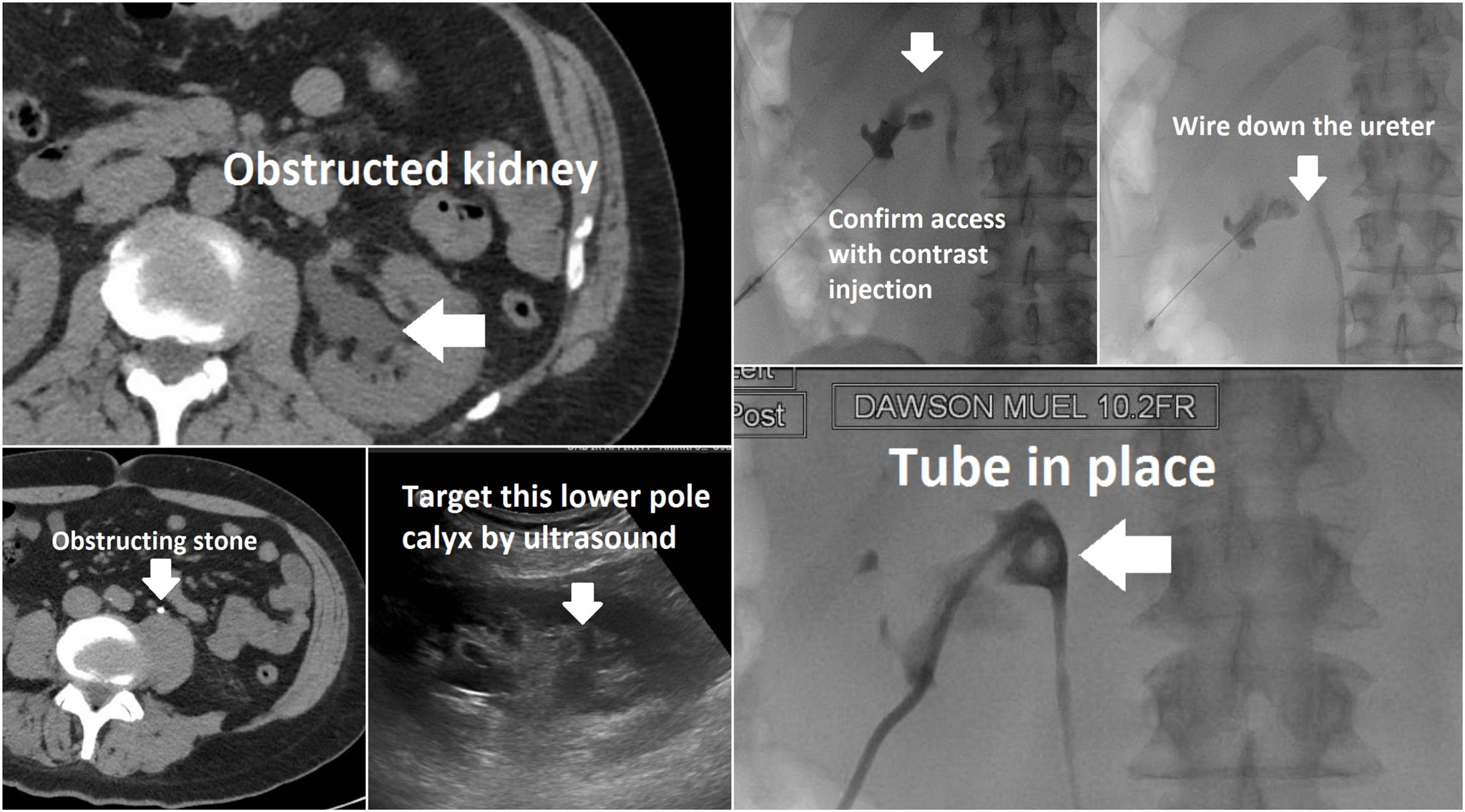Nephrostomy Tube Ultrasound