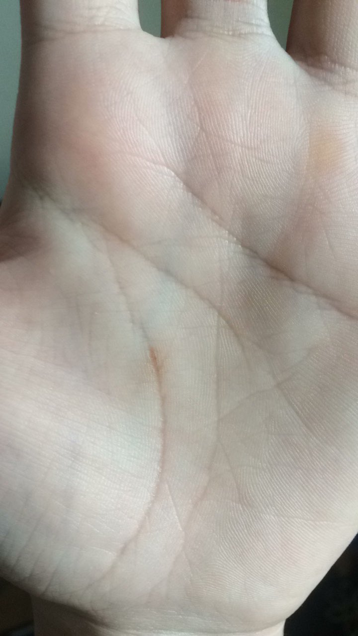 麗 なんか左の手のひらの中心に黒いシミみたいなものがある 弥勒みたいに風穴開くかな T Co Zrqg9ixxtn Twitter