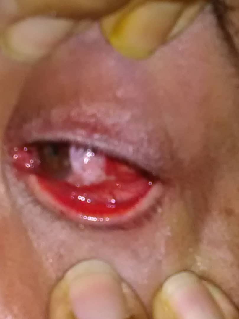 ASgustavo's tweet photo. #DENUNCIA El Preso Político Vasco Da Costa tiene un tumor en el ojo y el usurpador @NicolasMaduro niega la pronta y emergente operación #LibertadParaLosPresosPoliticos https://t.co/TFVby5hy6T