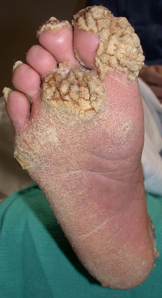 dunkleyfacts's tweet photo. Retweet if you like feet ๐
#crunchyNchunky #keepyoursockson https://t.co/hltCmiK4jm