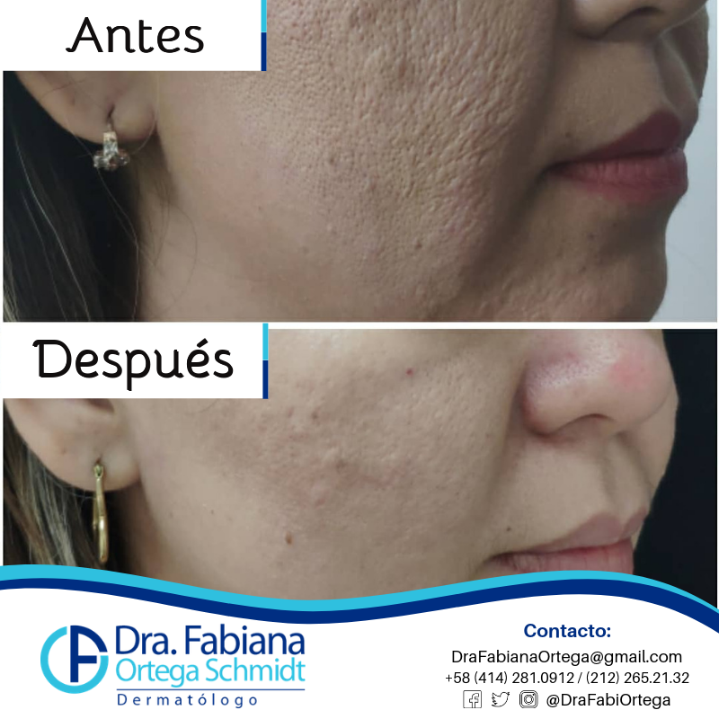 DraFabiOrtega's tweet photo. Resultados con #LaserPixel vean este increible resultado #Antes y #Despues
Para citas 📞 0414-2810912 📞
#Dermatologia #tratamientos #caracas #DraFabiOrtega https://t.co/1PXXwM0Mim