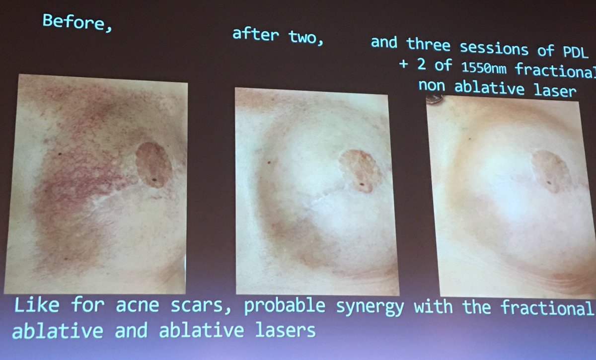 Lors du congrès sur les lasers, le Dr Olive a pu participer à une conférence sur l'intérêt de l'association des différentes technologies #Laser ainsi que du #Botox et de l'acide hyaluronique dans le traitement des #Cicatrices

#MédecineEsthetique #Dermatologie