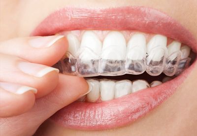 Balledds's tweet photo. What are the differences in doing teeth whitening at home with over-the-counter products versus in-office teeth whitening? Click to find out. https://t.co/QiJhGNXdSl #TeethWhitening #dentistry #dentist #dental #smile #teeth #cosmeticdentistry #dentalcare https://t.co/qekOOxfzTW