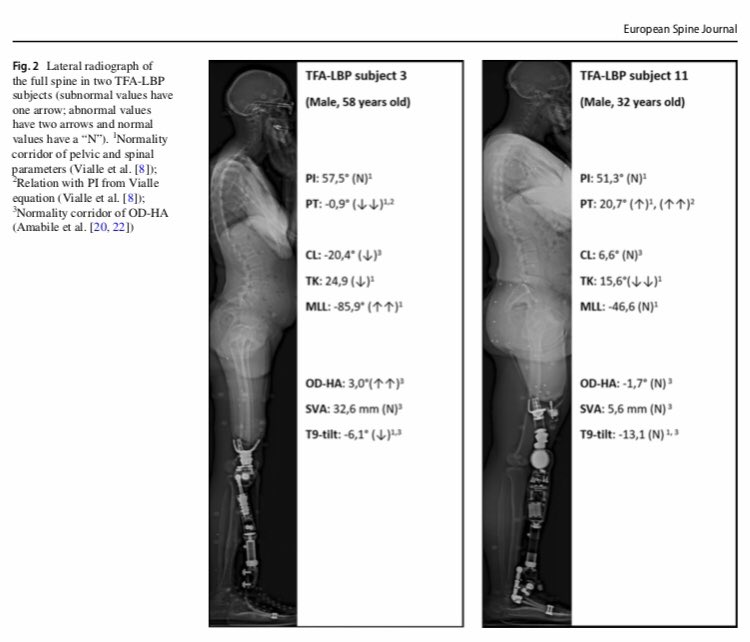 EurSpineJournal's tweet image. Check out this article about #spinopelvic #sagittalalignment of patients with transfemoral #amputation.
link.springer.com/article/10.100…
