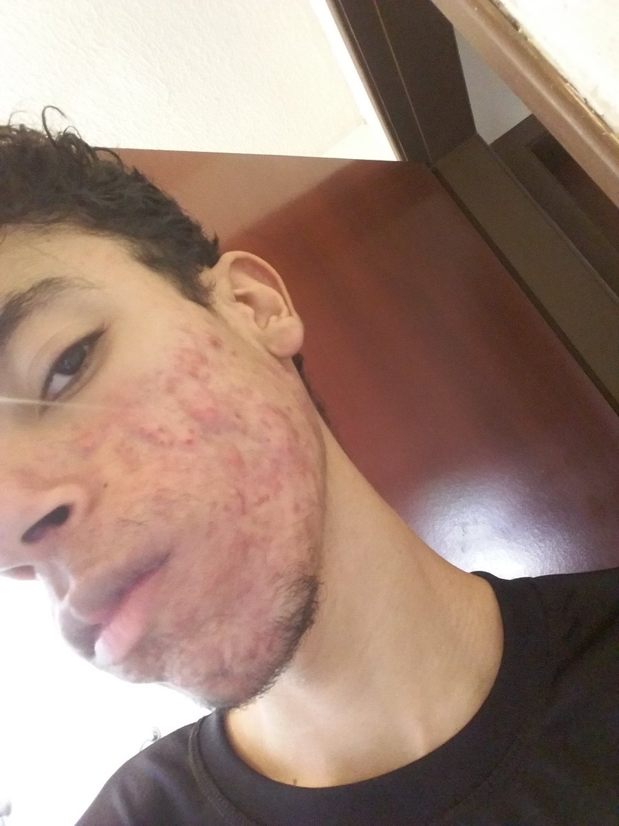 bitchtys's tweet photo. em 4 meses tomando o roacutan o meu rosto já MELHOROU MUITO AAAAAAAAAA PUTA QUE PARIU
te amo seu veneno https://t.co/HoaUsshmwr