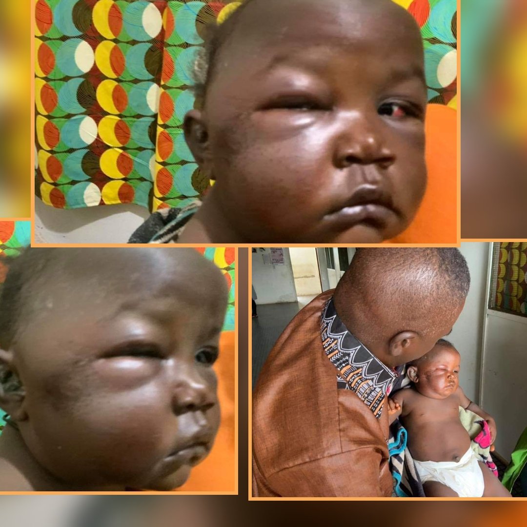YabaleftonlineC's tweet photo. Today was a very sad day when this baby was brought to the clinic, beaten by her father. We took the right step, turn the father over to the police and treated the child. Please pray for her.
@channelstv @atiku https://t.co/BdA22w06AR