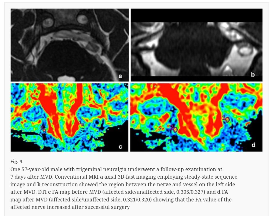 ActaNeuro's tweet image. #EditorsChoice: #Diffusion tensor imaging of microstructural alterations in the #trigeminal nerve due to #neurovascular contact/compression

#FreeToRead until 10 July

#neurosurgery #nsgy #MVD #ActaNeuro

bit.ly/313Seda