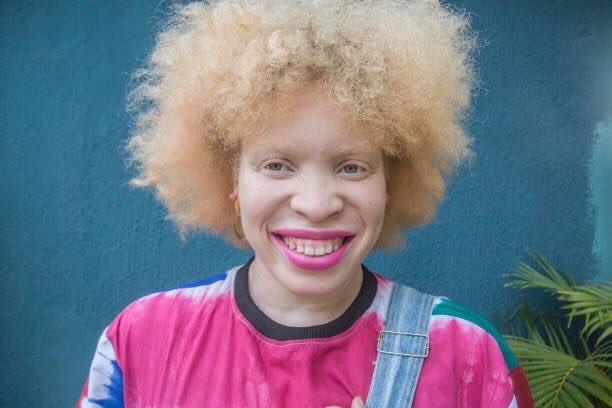 heycocopops's tweet photo. It's International Albinism Awareness Day, and I'd like to celebrate with a thread of amazing albinos I know/follow. Feel free to add π
I'll start with my humble self -
Writer, Model, Designer, Badass
#stillstrong #iaad #iaad2019 #AlbinismDay #projectshowus #showus https://t.co/QWVRqQKtBL