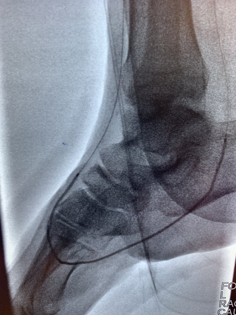 aameermd's tweet photo. Diabetics are not predictable ... single vessel runoffs might not be enough to heal a wound. Angiography and directed therapy angiosome guided therapy might offer better chance of healing. #pedal_loop #angiosome #foot_salvage #diabetes #vascular https://t.co/lT6L8cQE53