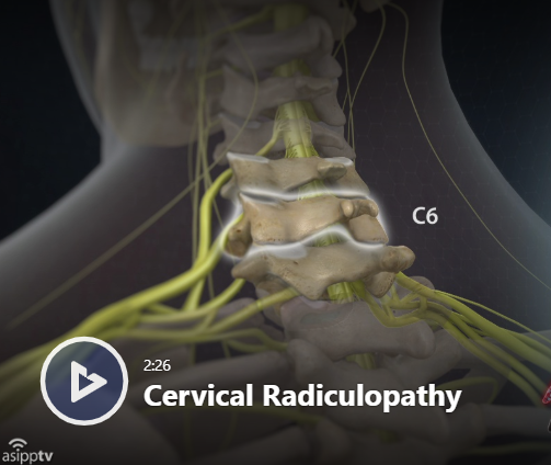 Do you have a pinched nerve or neck pain? Could it be a Cervical Radiculopathy? What Is Cervical Radiculopathy? spinecaremw.com/blog-post/what… #BestPainDoctor