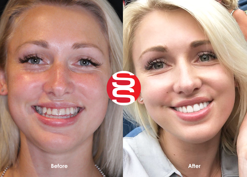 SmileStylistTO's tweet image. From #openbite to perfect bite - thesmilestylist.ca #beautiful to #gorgeous #smile #dentist #ThesmileStylist #Toronto #Oakville