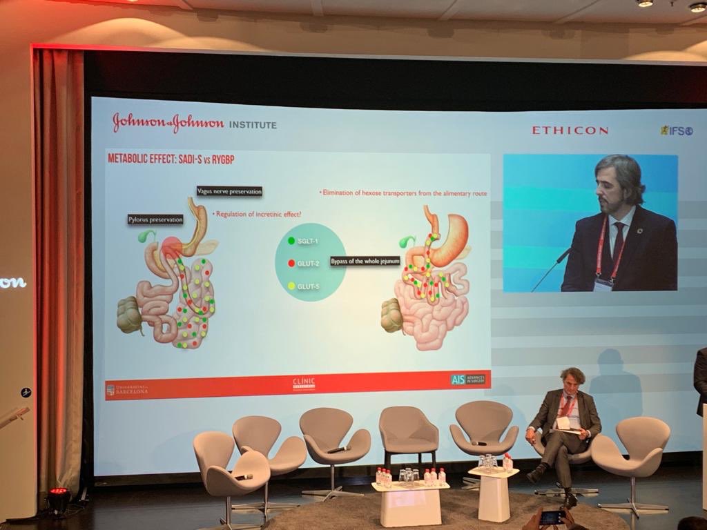 Jose M. Balibrea MD, PhD, FACS (@balibreajose) on Twitter photo It’s been as tough as interesting 2 defend SADI-S as a bariatric emerging procedure. This is an excellent option, however it is NOT 4 every patient. Optimal results only come after good careful patient selection #JnJBariatricSymposium <a href="/IfsoSecretariat/">IFSO</a> <a href="/AISChannel/">AIS Channel</a> <a href="/hospitalclinic/">Hospital Clínic</a> It’s been as tough as interesting 2 defend SADI-S as a bariatric emerging procedure. This is an excellent option, however it is NOT 4 every patient. Optimal results only come after good careful patient selection #JnJBariatricSymposium <a href="/IfsoSecretariat/">IFSO</a> <a href="/AISChannel/">AIS Channel</a> <a href="/hospitalclinic/">Hospital Clínic</a>