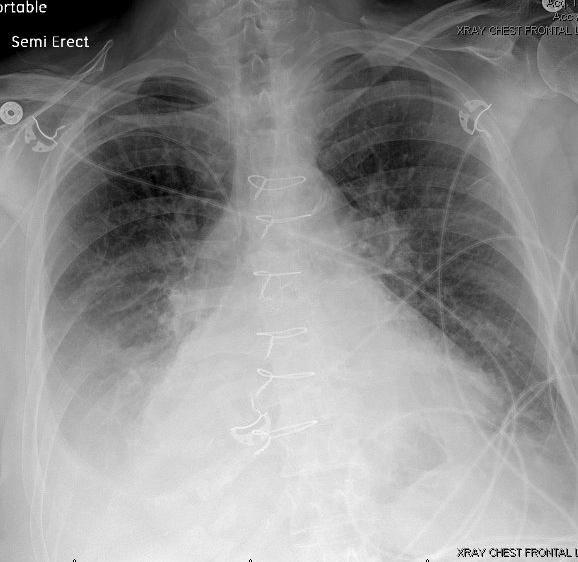 IMPOCUSFocus's tweet image. Hey #POCUS fans - I know all have been holding your breath (pun intended) for another #POCUSreport!
75 yo F s/p elective ENT procedure complicated by difficulty extubating. ? aspiration event. Transferred to the floor for further management of persistent hypoxia. CXR here.

1/
