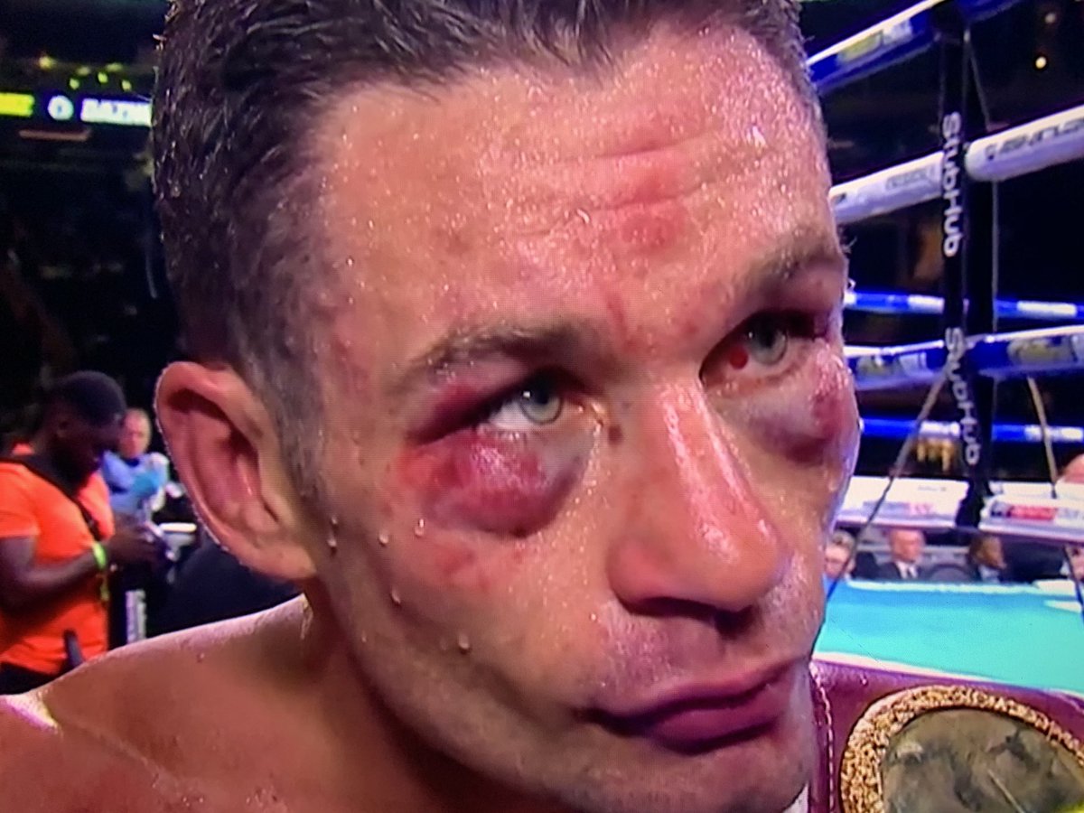 BoxingMs's tweet photo. Algeri knows he’s been in a scrap! Hard luck @TommyCoyle89 big balls getting up after the bodyshot in the 4th 👊🏼 #AlgieriCoyle https://t.co/bNhCipdeCs