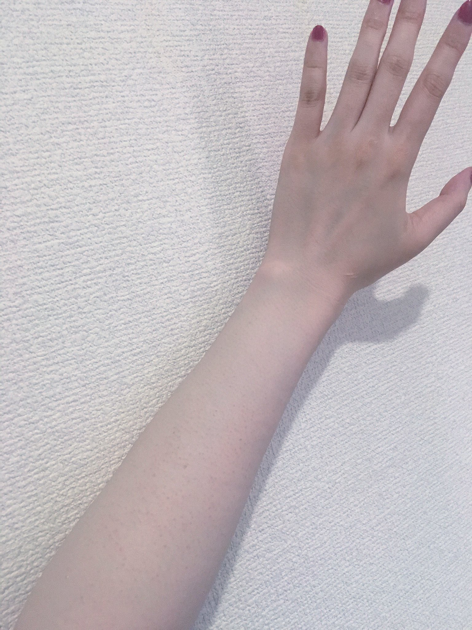 はうあ 腕の毛孔性苔癬を隠したい気持ちよりも 涼しさを選んだモコガールです 昨日 五分袖のトップスを着てたら 彼氏にとつぜん 腕をつかまれ えっ ブツブツどうしたの と言われました わたしは 冷房で鳥肌立ってるんﾀﾞﾄｵﾓｳ と誤魔化した