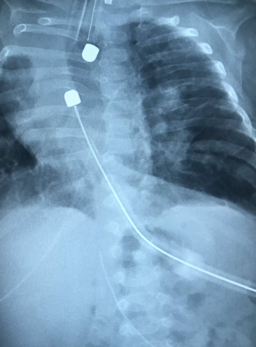IRtmke's tweet photo. Fmr 27 wk old premie w/  esophageal atresia and several cardiopulmonary comorbidities. Failed primary surg eso repair. Magnet-tip Flourish catheter system placed by #PedsIR w/ full apposition in 6 days 🎉 now ��pressure cooking’ an anastomosis! 🤞🏻 for good news for pt &amp; parents! https://t.co/gU5Nn5tJy8