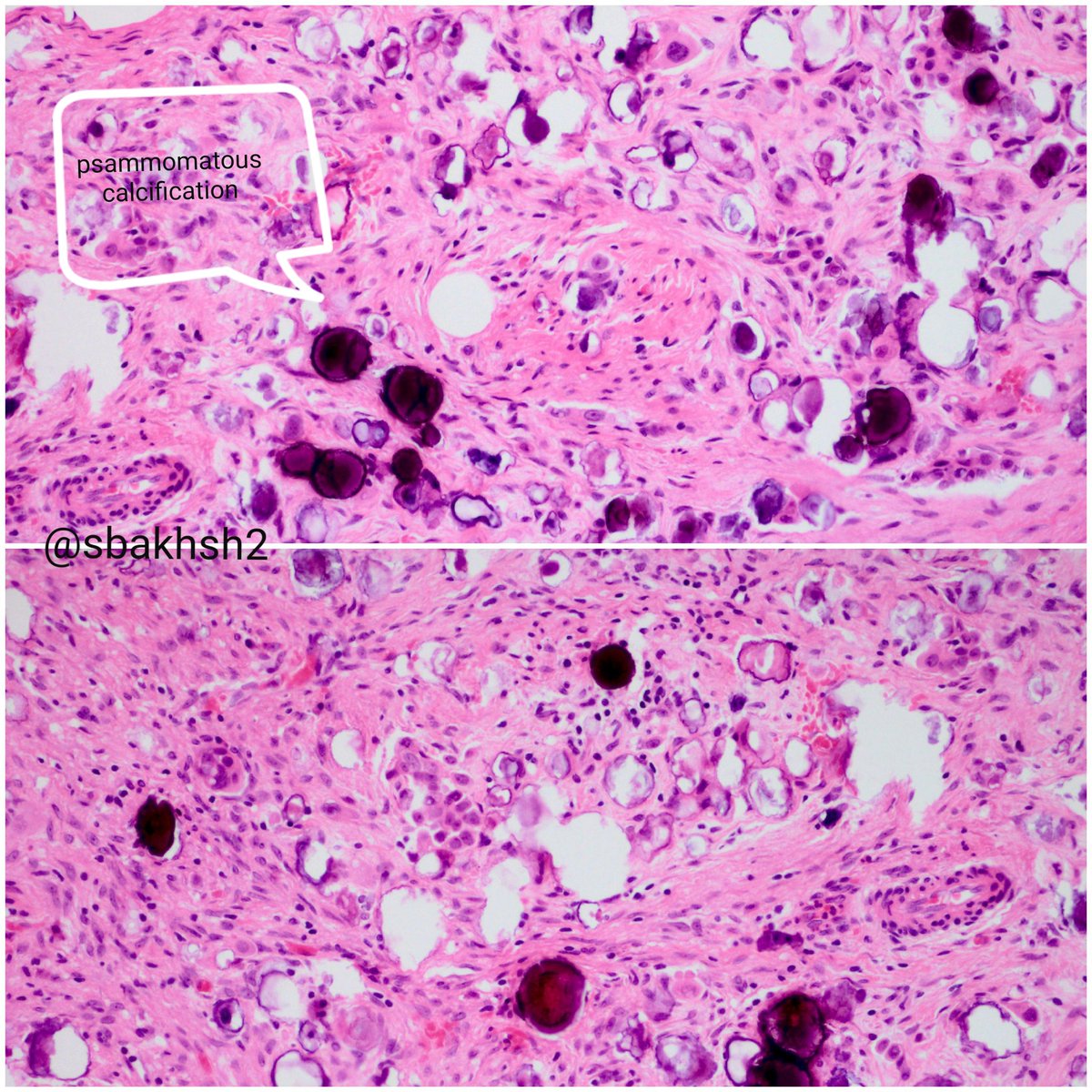 sbakhsh2's tweet photo. Omental &amp; peritoneal bxs :
🔬 invasive ovarian low grade serous carcinoma.
#Gynpath #pathology https://t.co/fkmT3xXtxw